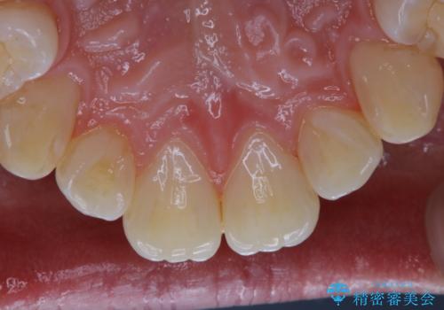 PMTC 歯のお掃除の治療後