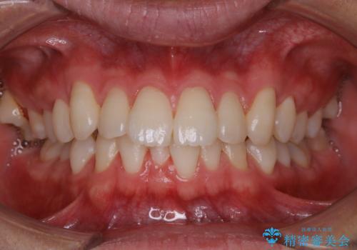 PMTC 歯のお掃除の症例 治療後