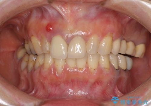 折れてしまった前歯 オールセラミックブリッジで自然な口元にの治療前