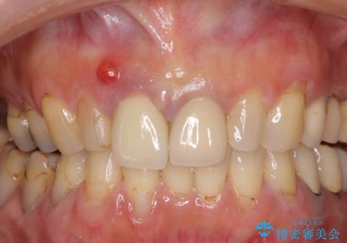 折れてしまった前歯 オールセラミックブリッジで自然な口元にの治療前