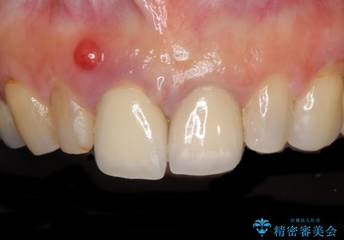 折れてしまった前歯 オールセラミックブリッジで自然な口元にの症例 治療前