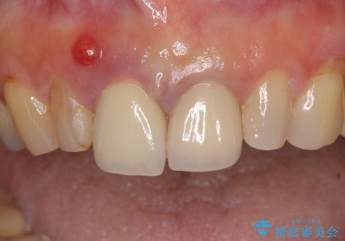 折れてしまった前歯 オールセラミックブリッジで自然な口元にの治療前