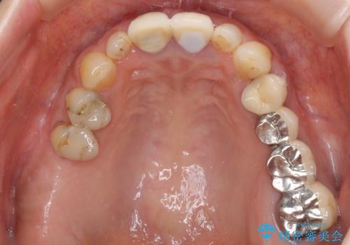 折れてしまった前歯 オールセラミックブリッジで自然な口元にの治療前