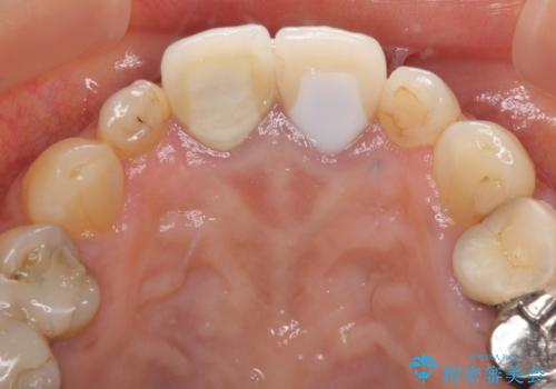 折れてしまった前歯 オールセラミックブリッジで自然な口元にの治療前