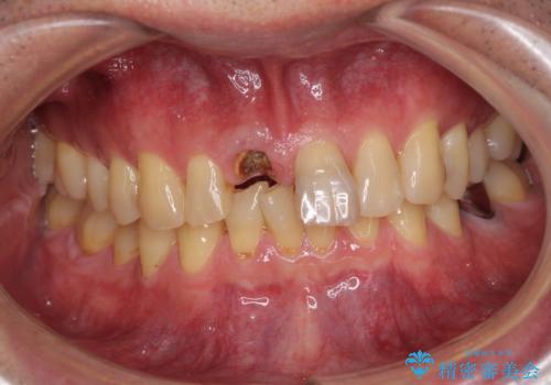 折れてしまった前歯 インプラントによる補綴治療の治療前