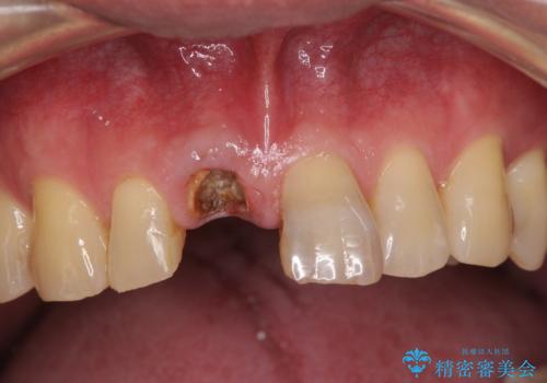 折れてしまった前歯 インプラントによる補綴治療の症例 治療前