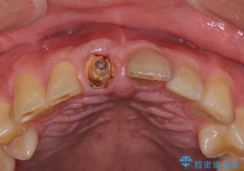 折れてしまった前歯 インプラントによる補綴治療の治療前