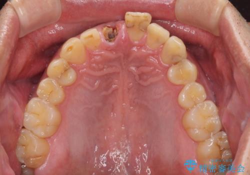 折れてしまった前歯 インプラントによる補綴治療の治療前