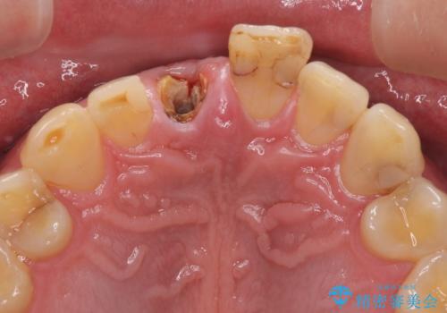 折れてしまった前歯 インプラントによる補綴治療の治療前