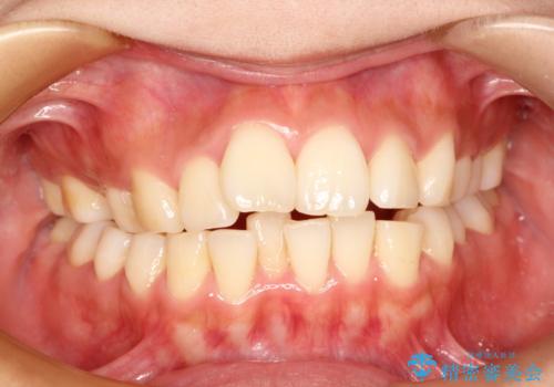 前歯で咬めない・出っ歯　抜歯矯正で整った上下の前歯への症例 治療前