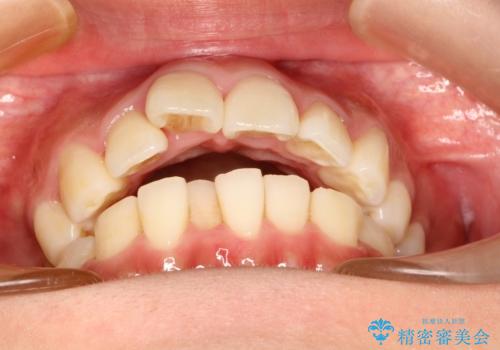前歯で咬めない・出っ歯 抜歯矯正で整った上下の前歯への治療前