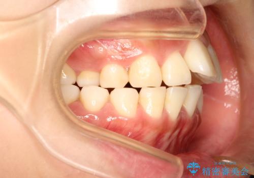 前歯で咬めない・出っ歯 抜歯矯正で整った上下の前歯への治療前
