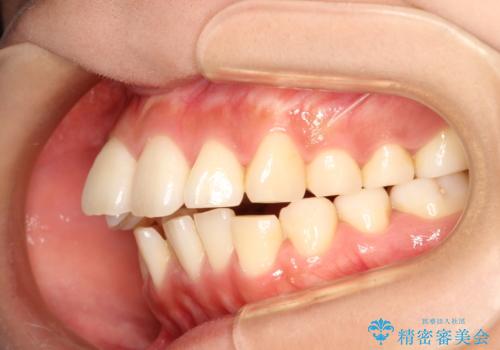 前歯で咬めない・出っ歯　抜歯矯正で整った上下の前歯への治療前