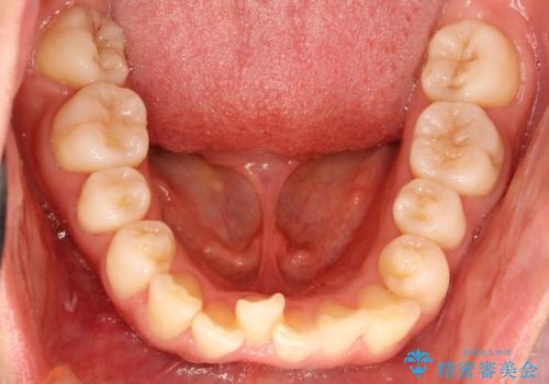 前歯で咬めない・出っ歯 抜歯矯正で整った上下の前歯への治療前