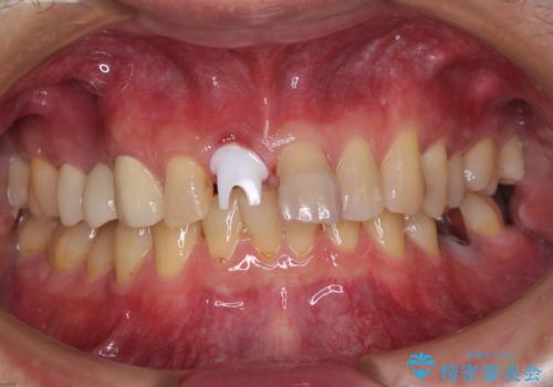 折れてしまった前歯 インプラントによる補綴治療の治療中
