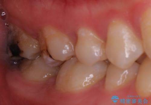 広範囲にわたる虫歯をセラミックで治療の症例 治療前