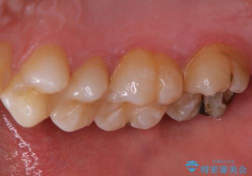 広範囲にわたる虫歯をセラミックで治療の治療前