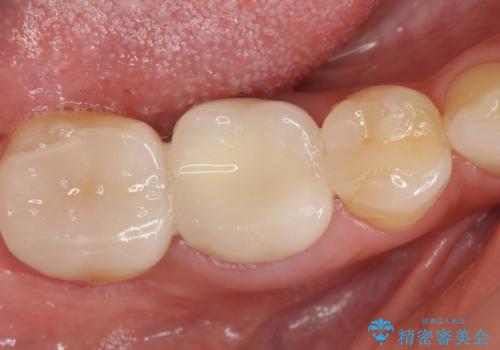 オールセラミッククラウン　他院にて抜歯を勧められた歯の治療の症例 治療前
