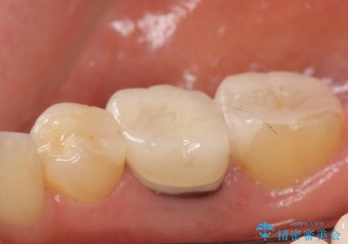 オールセラミッククラウン　他院にて抜歯を勧められた歯の治療の治療前
