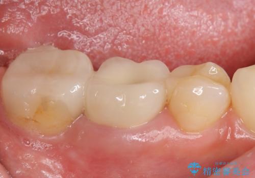 オールセラミッククラウン 他院にて抜歯を勧められた歯の治療の治療前