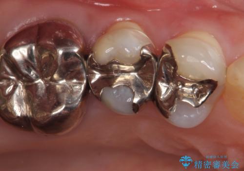 オールセラミッククラウン ズキズキ痛む歯の治療の治療前