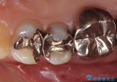 オールセラミッククラウン ズキズキ痛む歯の治療の治療前