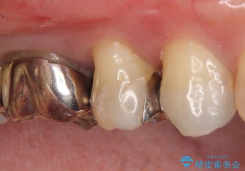 オールセラミッククラウン ズキズキ痛む歯の治療の症例 治療前