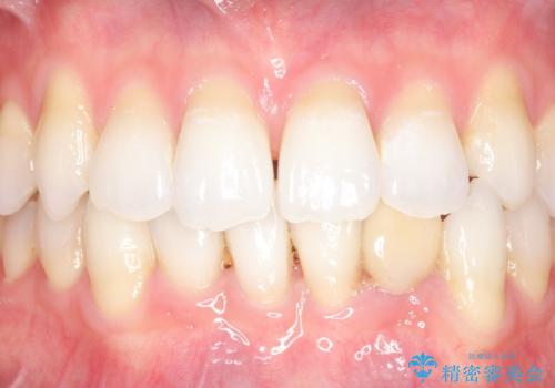 オールセラミッククラウン 矯正で綺麗に並ばなかった前歯の補綴の治療前