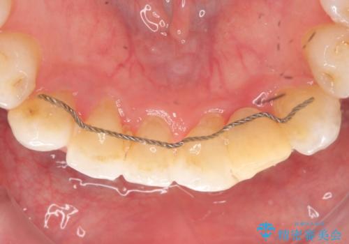 オールセラミッククラウン 矯正で綺麗に並ばなかった前歯の補綴の治療前