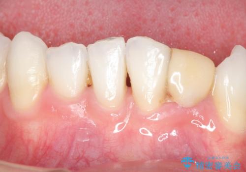 オールセラミッククラウン 矯正で綺麗に並ばなかった前歯の補綴の症例 治療前