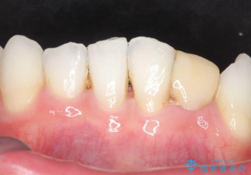 オールセラミッククラウン 矯正で綺麗に並ばなかった前歯の補綴の治療前