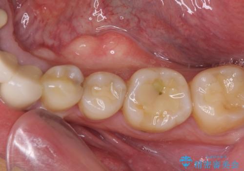 舌側の骨隆起切除とセラミックインレーによるむし歯治療の症例 治療前