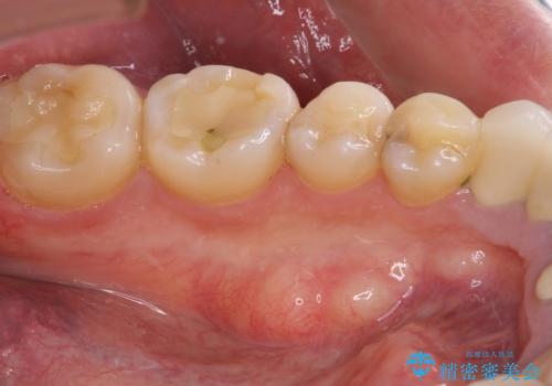舌側の骨隆起切除とセラミックインレーによるむし歯治療の治療前
