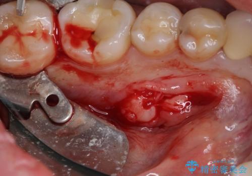 舌側の骨隆起切除とセラミックインレーによるむし歯治療の治療前