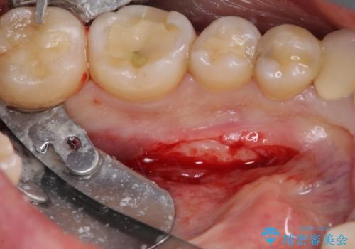 舌側の骨隆起切除とセラミックインレーによるむし歯治療の治療中