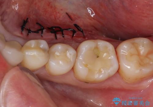 舌側の骨隆起切除とセラミックインレーによるむし歯治療の治療中