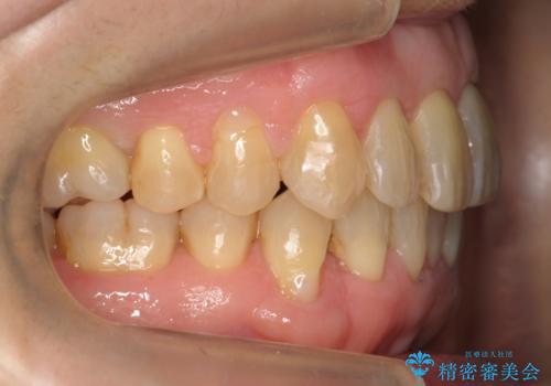 前歯のがたつき　インビザラインで抜歯矯正の治療後