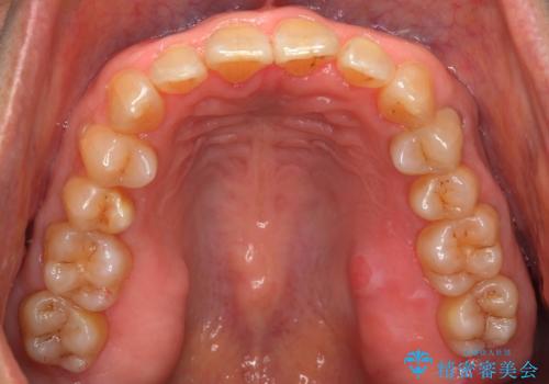 前歯のがたつき　インビザラインで抜歯矯正の治療後