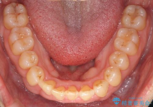 前歯のがたつき インビザラインで抜歯矯正の治療後