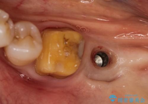 失った歯のインプラントでの咬合回復の治療中