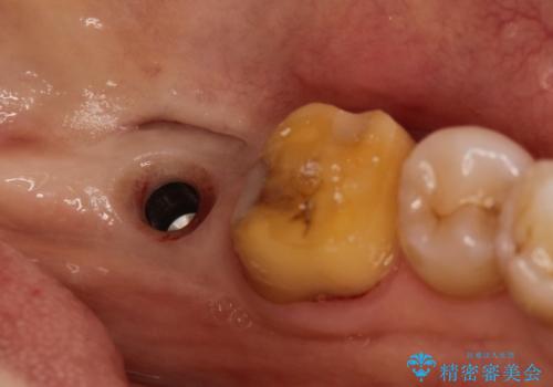 失った歯のインプラントでの咬合回復の治療中