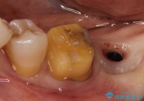 失った歯のインプラントでの咬合回復の治療中