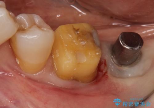 失った歯のインプラントでの咬合回復の治療後