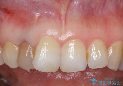 オールセラミッククラウン 変色が気になる前歯の治療の治療前