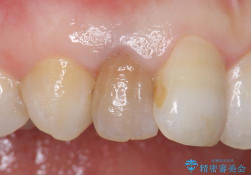 オールセラミッククラウン 変色が気になる前歯の治療の治療前