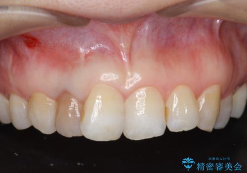 オールセラミッククラウン　変色が気になる前歯の治療の治療前