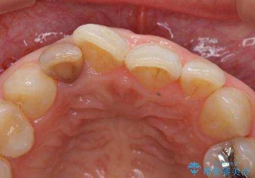 オールセラミッククラウン 変色が気になる前歯の治療の治療前