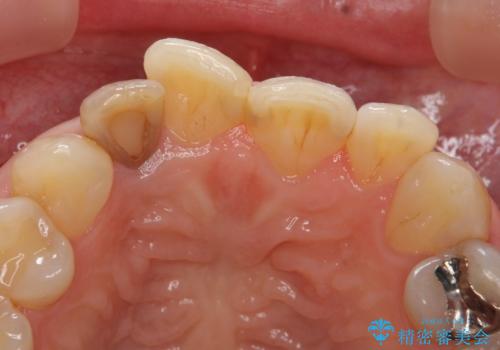 オールセラミッククラウン 変色が気になる前歯の治療の治療前