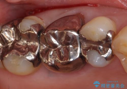 オールセラミッククラウン 銀歯と歯茎の隙間が気になるの治療前