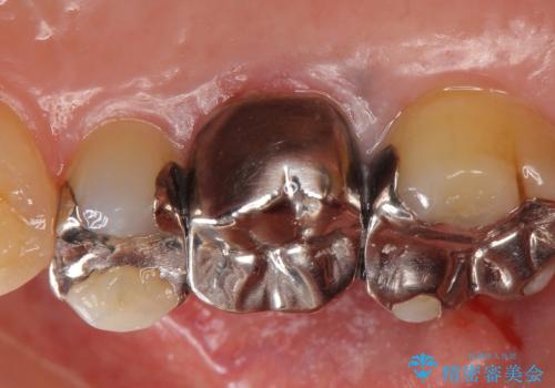 オールセラミッククラウン 銀歯と歯茎の隙間が気になるの治療前